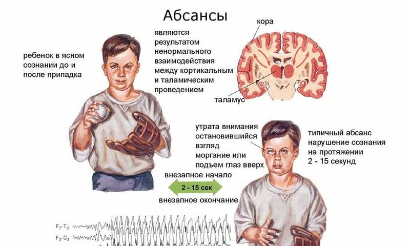 Малые припадки. Абсансная эпилепсия симптомы. Эпилептический припадок абсанс. Детская абсанс эпилепсия. Атипичные абсансы.