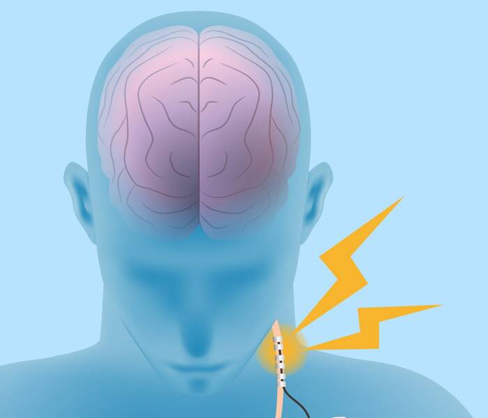 Электростимуляция блуждающего нерва или VNS-терапия